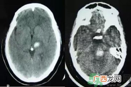 脑出血的发病因素是什么？脑出血的并发症有哪些？