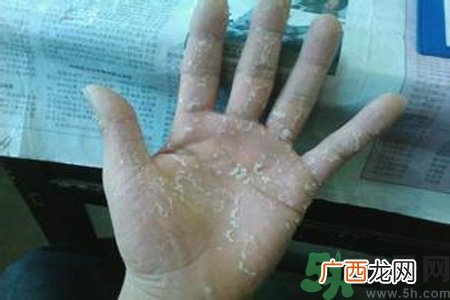 引起手足癣的主要原因?手足癣会引发什么疾病?