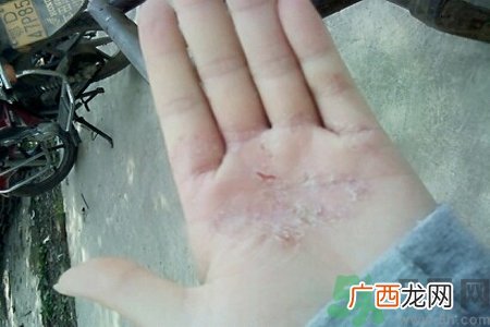 引起手足癣的主要原因?手足癣会引发什么疾病?