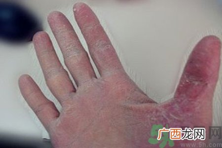 引起手足癣的主要原因?手足癣会引发什么疾病?