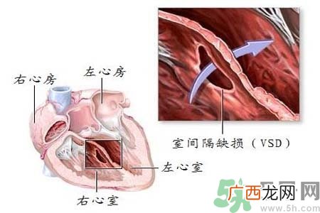 心脏病是怎么形成的？易发人群有哪些？