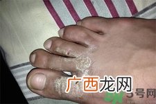 手足癣是什么？手足癣症状有什么？