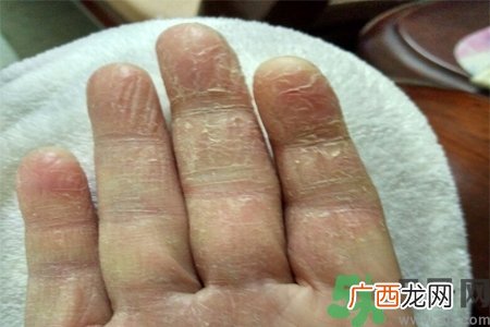手足癣是什么？手足癣症状有什么？
