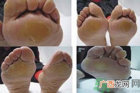 手足癣是什么？手足癣症状有什么？