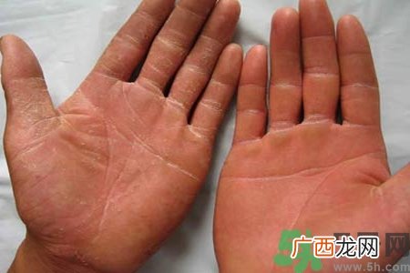 手足癣是什么？手足癣症状有什么？