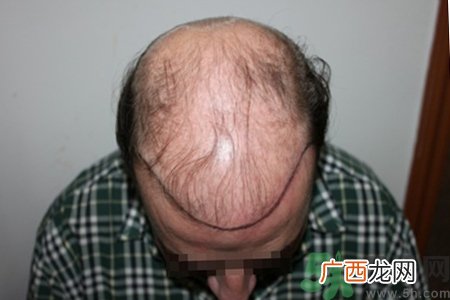 脱发会遗传吗？脱发遗传可以治疗吗？