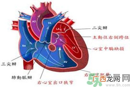 先天性心脏病需要注意什么？