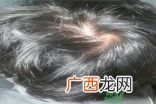 脱发的高发人群有哪些？如何预防脱发？