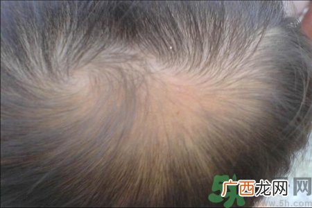 脱发的高发人群有哪些？如何预防脱发？