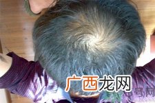 脱发的高发人群有哪些？如何预防脱发？
