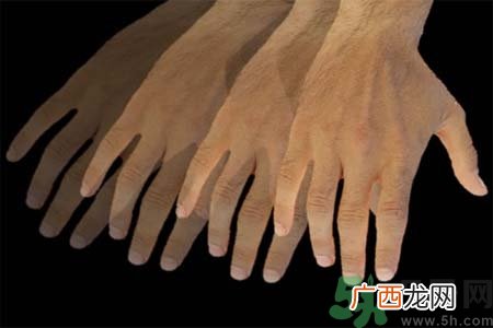 帕金森是什么？帕金森的症状有哪些？