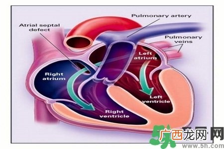 心脏病的症状是什么？心脏病的种类有哪些？