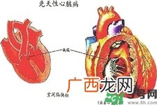 心脏病的症状是什么？心脏病的种类有哪些？