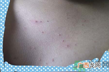 胸部长痘痘怎么办？胸部长痘痘需要注意什么？