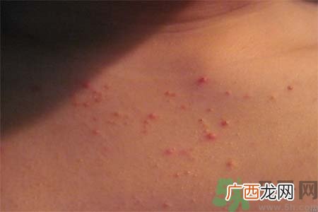 胸部长痘痘怎么办？胸部长痘痘需要注意什么？