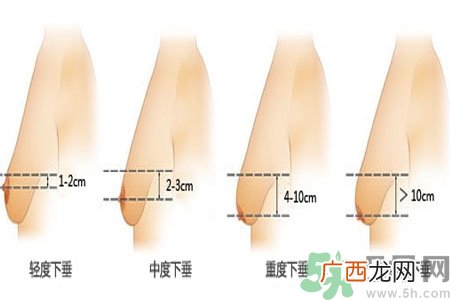 胸部松弛的原因是什么？胸部松弛该怎么办？