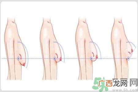 胸部松弛的原因是什么？胸部松弛该怎么办？