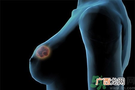 乳房有硬块正常吗？乳房有肿块怎么回事？
