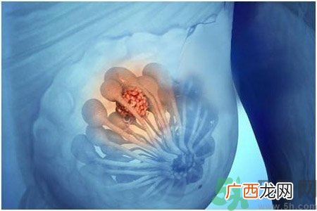 乳房有硬块正常吗？乳房有肿块怎么回事？
