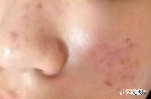 脸上的痘印能治好吗 男脸上的痘印怎么去除