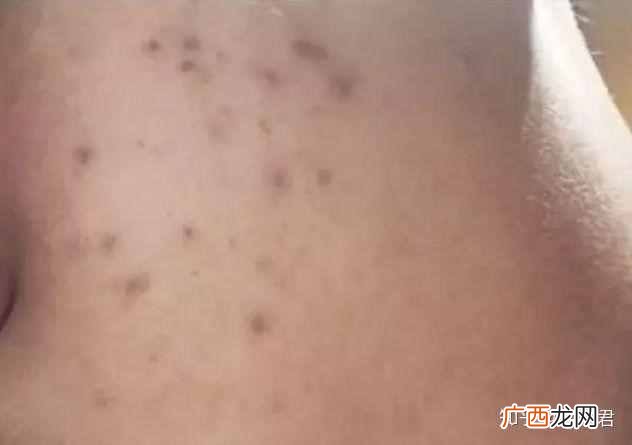 脸上的痘印能治好吗 男脸上的痘印怎么去除