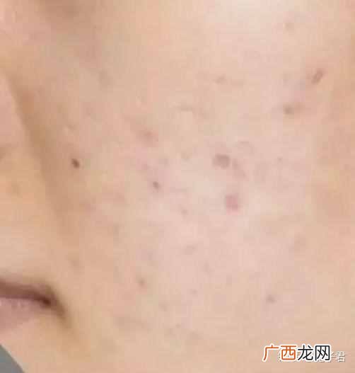 脸上的痘印能治好吗 男脸上的痘印怎么去除