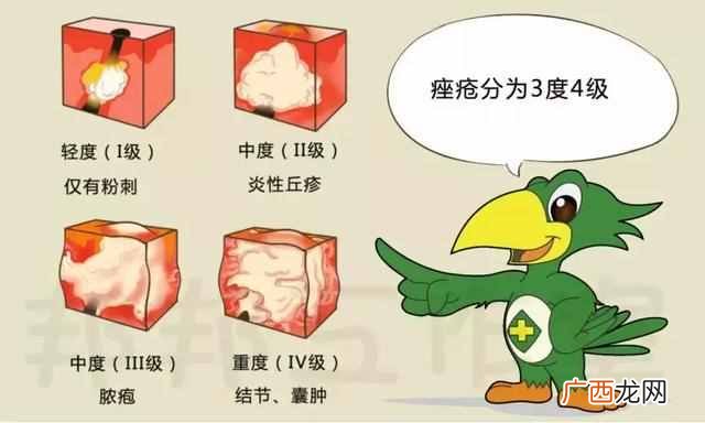 怎么去除黑头粉刺白头（鼻子黑头粉刺用盐可以