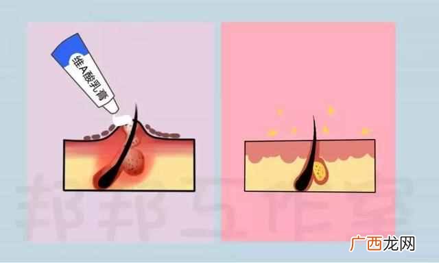 怎么去除黑头粉刺白头（鼻子黑头粉刺用盐可以