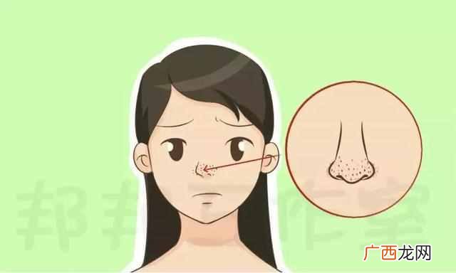 怎么去除黑头粉刺白头（鼻子黑头粉刺用盐可以