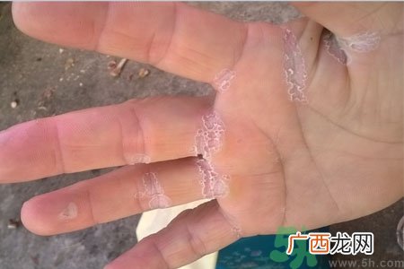 手掌脱皮的危害有哪些?如何预防手掌脱皮?