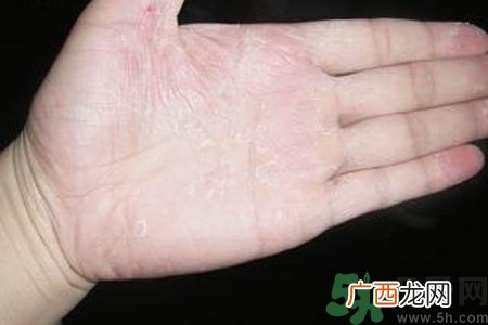 手掌脱皮的危害有哪些?如何预防手掌脱皮?