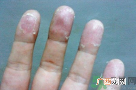 手掌脱皮的危害有哪些?如何预防手掌脱皮?