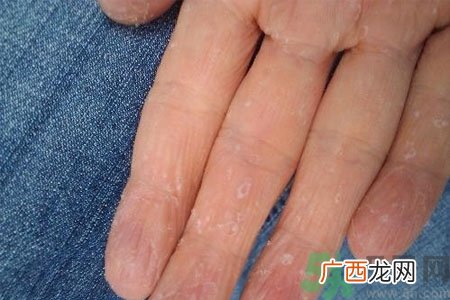 手掌脱皮的危害有哪些?如何预防手掌脱皮?