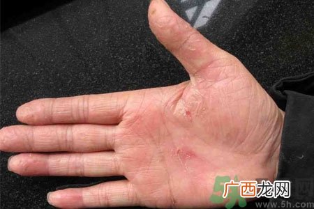 手掌脱皮的危害有哪些?如何预防手掌脱皮?