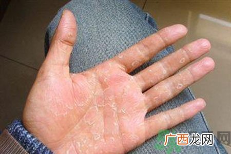 手掌脱皮的危害有哪些?如何预防手掌脱皮?
