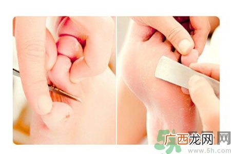 鸡眼怎么能彻底根治？如何预防脚上长鸡眼？