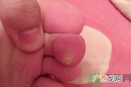 鸡眼怎么能彻底根治？如何预防脚上长鸡眼？