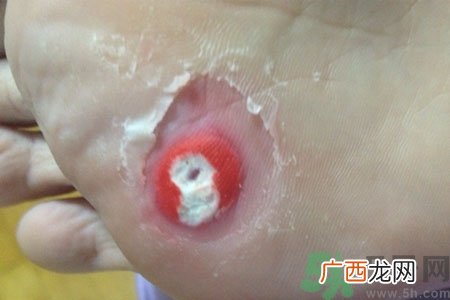 鸡眼怎么能彻底根治？如何预防脚上长鸡眼？
