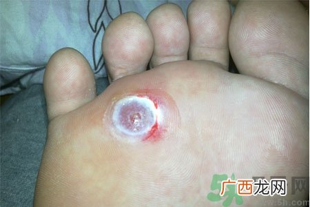 鸡眼怎么能彻底根治？如何预防脚上长鸡眼？