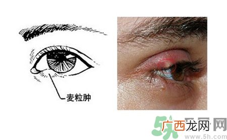 眼皮里长了个疙瘩是怎么回事?眼睛里长了个小白点怎么办?