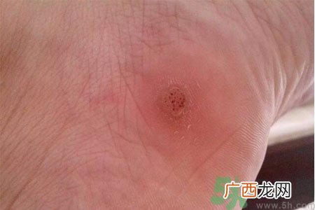 脚上长鸡眼是怎么回事？脚上长鸡眼是怎么办？