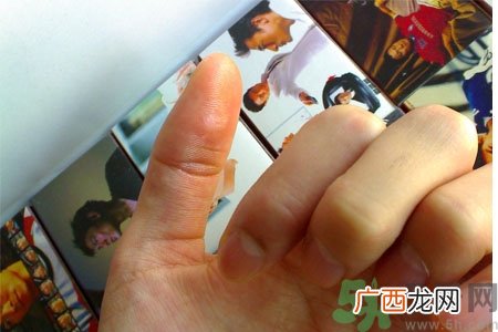 脚上长鸡眼是怎么回事？脚上长鸡眼是怎么办？