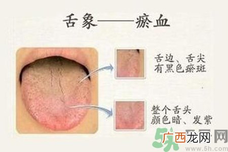 血瘀体质吃什么？血瘀体质怎么调理？