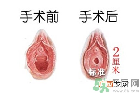 什么人不能做处女膜修补术？处女膜修补术会留疤吗？