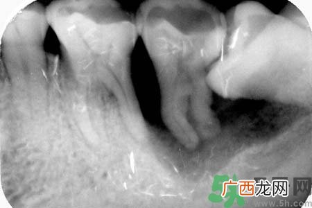 智齿横着长怎么办？智齿横着长一定要拔了吗？