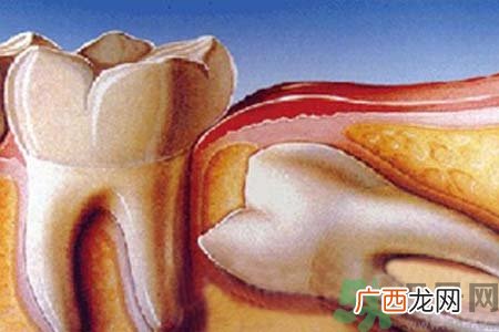 多少岁开始长智齿？智慧牙长到多少岁？