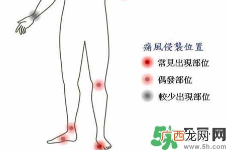 引发痛风的原因是什么?痛风病人饮食需注意什么好?