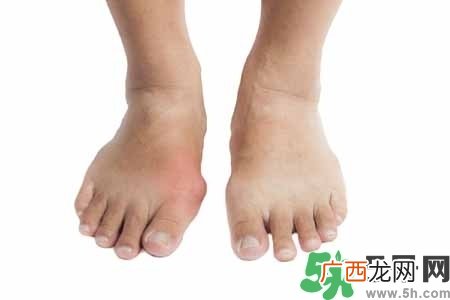 引发痛风的原因是什么?痛风病人饮食需注意什么好?