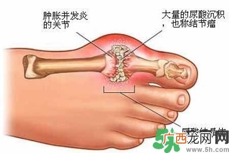 引发痛风的原因是什么?痛风病人饮食需注意什么好?
