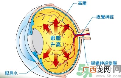 青光眼可以治愈吗？青光眼怎样治疗？